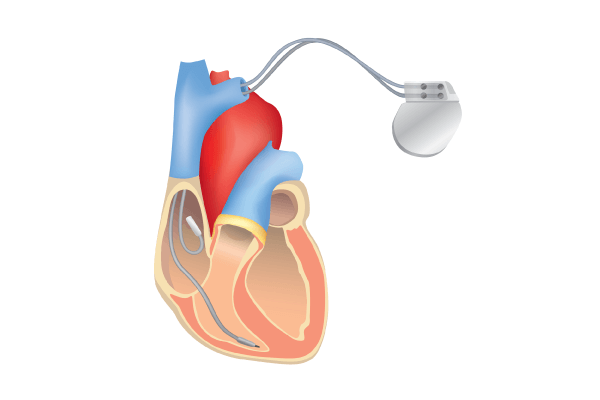 ペースメーカーのイメージ