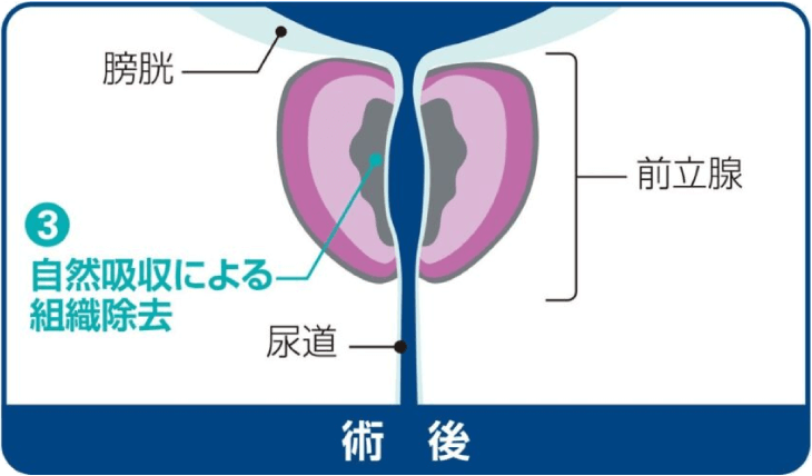 術後 ③自然吸収による組織除去