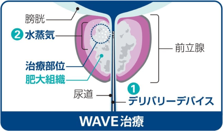 WAVE治療 ①デリバリーデバイス ②水蒸気